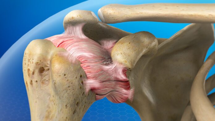 frozen shoulder