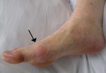 gout