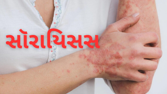 સોરાઈસીસ