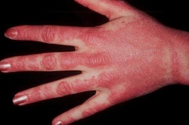 Dermatomyositis skin disease 