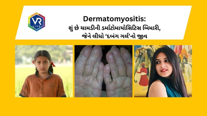 Suhani Bhatnagar : Dermatomyositis skin disease