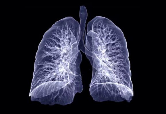 lung damage after Covid