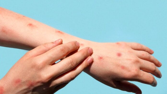Measles chicken pox