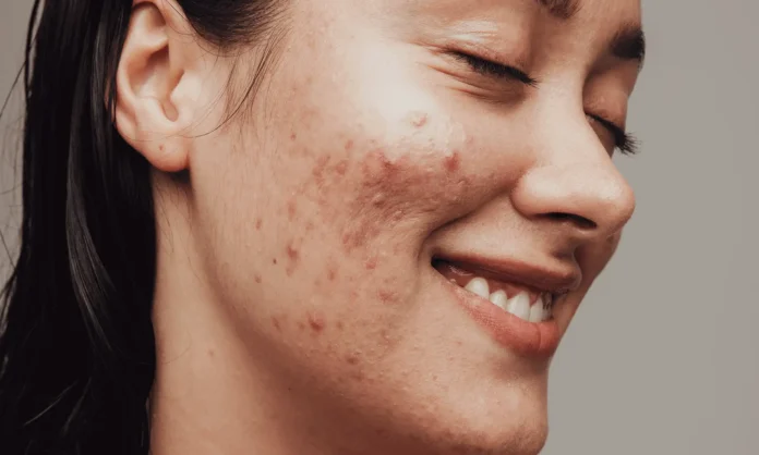 pimples