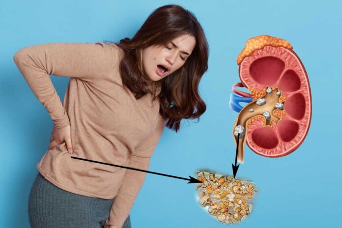 Kidney-Stone