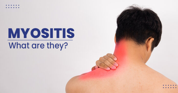 Myositis-causes-treatment