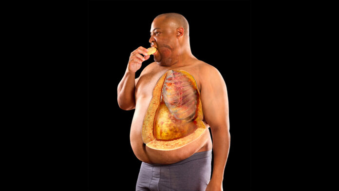 obesity