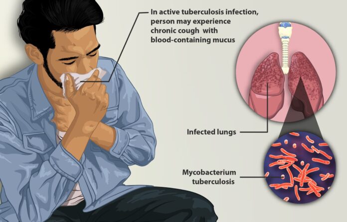 TB in India: ખુલ્લામાં થૂંકવાની આદતને કારણે દેશમાં ટીબીના દર્દીઓ વધ્યા! વિશ્વના 27% દર્દીઓ ભારતમાં