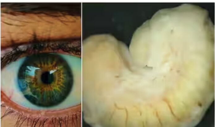 Infection: પરોપજીવી 2 વર્ષ સુધી મહિલાની આંખોમાંથી લોહી ચૂસતું રહ્યું... મગરનું માંસ ખાવાથી લાગ્યો હતો ચેપ