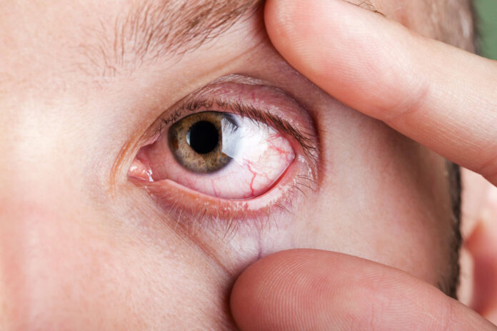 dry eyes