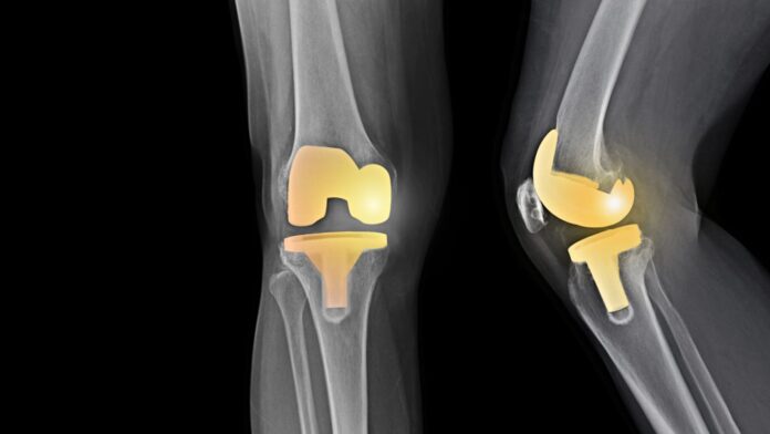 knee replacement